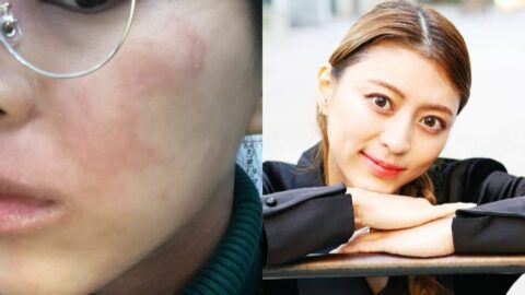 アトピー肌の29歳女性｢人前で水着に｣激変のワケ | 筋トレ社会人のキャリア論 | 東洋経済オンライン